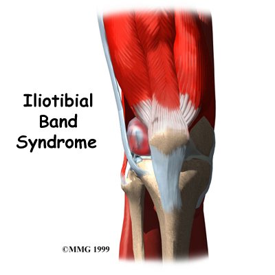 can-we-stretch-the-itbCan we stretch the Iliotibial Band (ITB)?